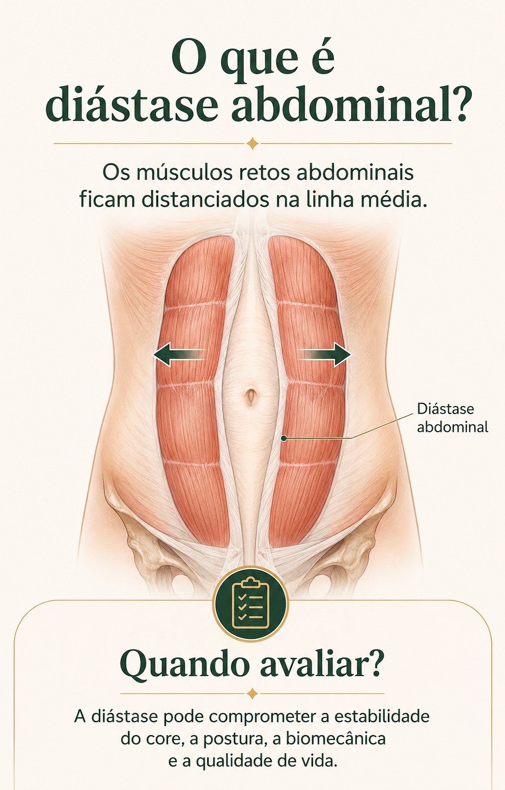 Ilustração médica mostrando o afastamento dos músculos retos abdominais na diástase